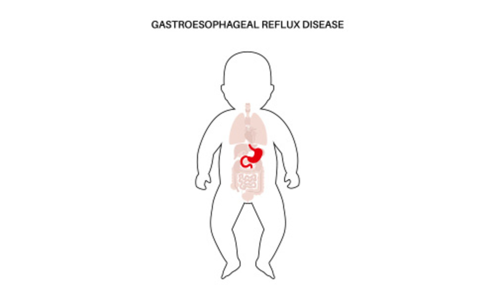 Causes and Risk Factors of Reflux in Babies