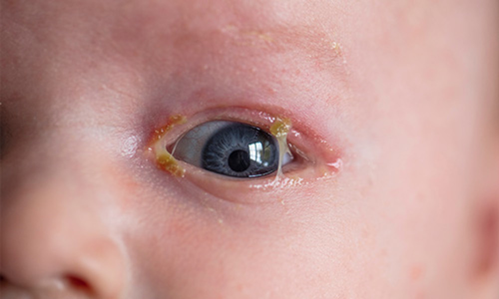Causes of Pink Eye in Babies and Toddlers