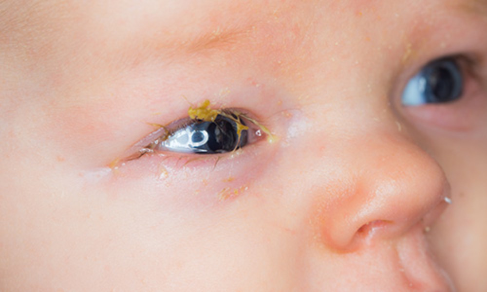 Can pink eye become more serious? How long does it usually take to clear in babies and toddlers?