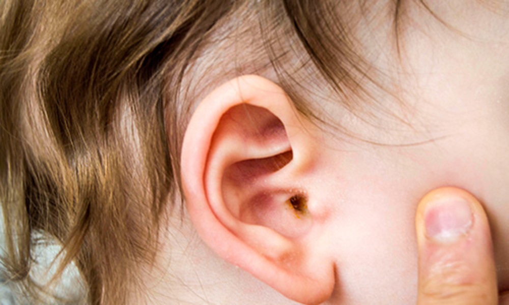 How To Prevent Ear Infections In Babies? 7 Practical Tips
