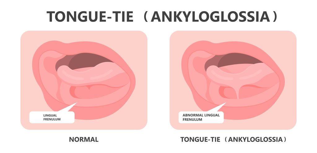What is Tongue-Tie?