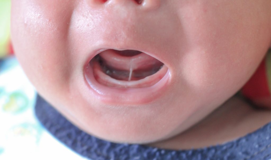 Tongue Tied Babies (Ankyloglossia) Signs, Causes & Treatment