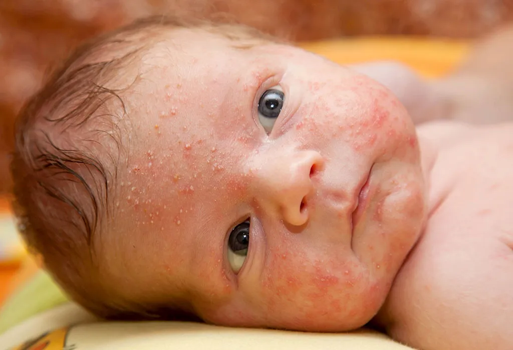 Understanding the Symptoms of Baby Acne
