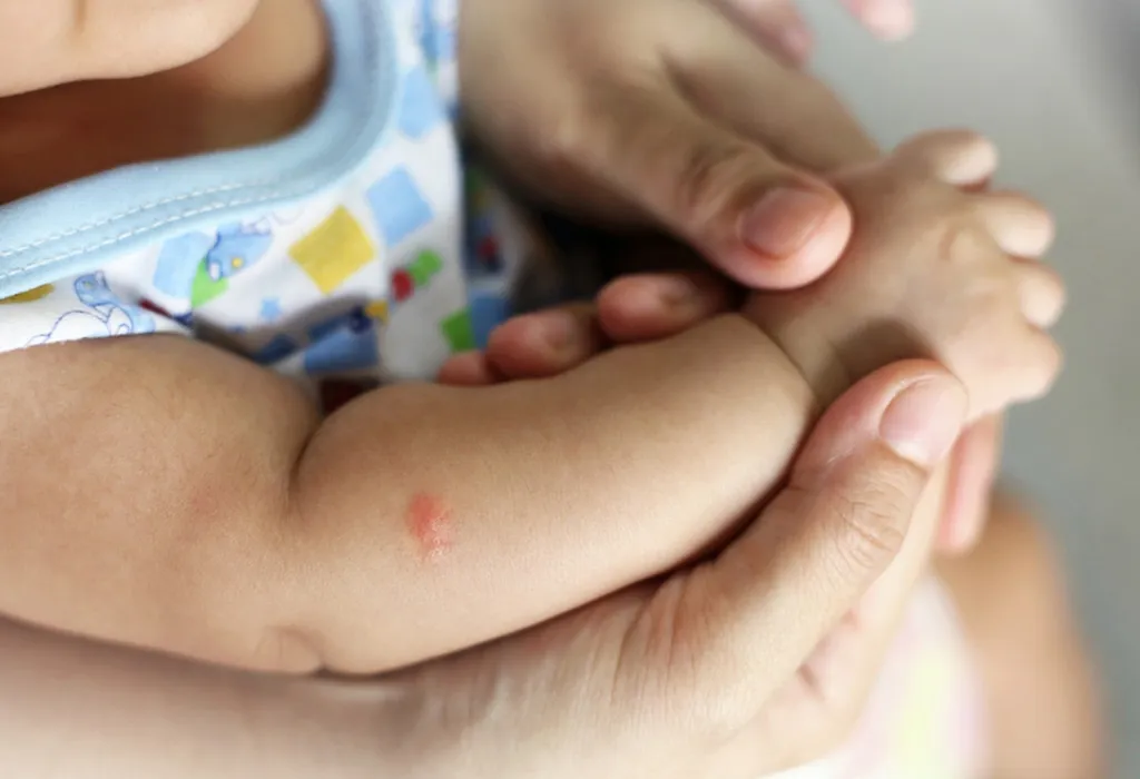 Home Remedies: How To Treat Mosquito Bites On Babies