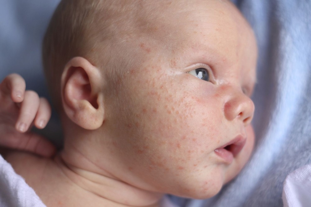 What Causes Baby Acne?
