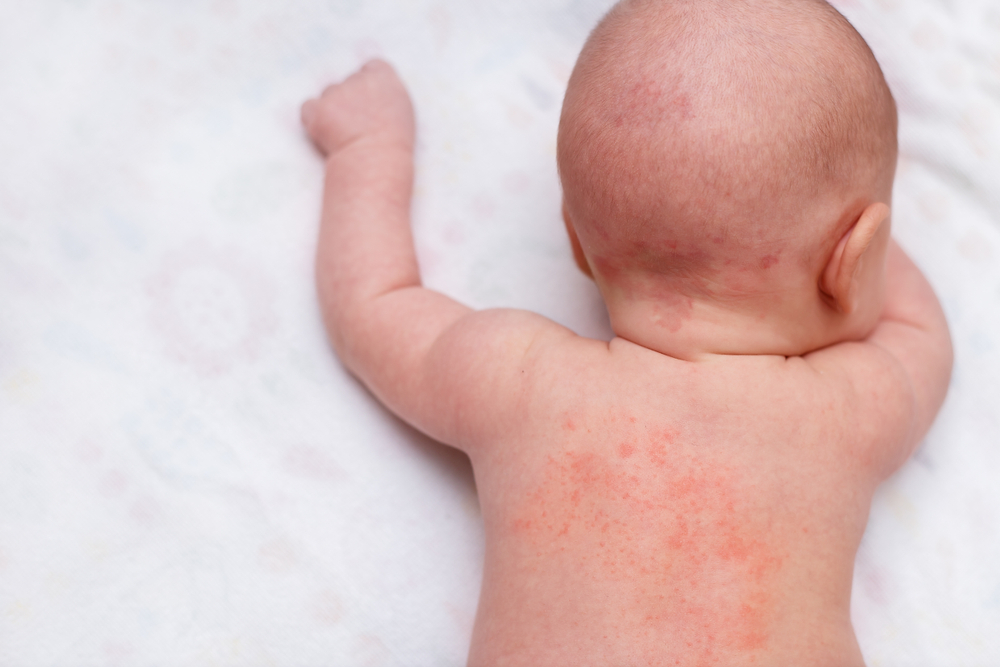 What to Do if Your Baby Gets a Heat Rash
