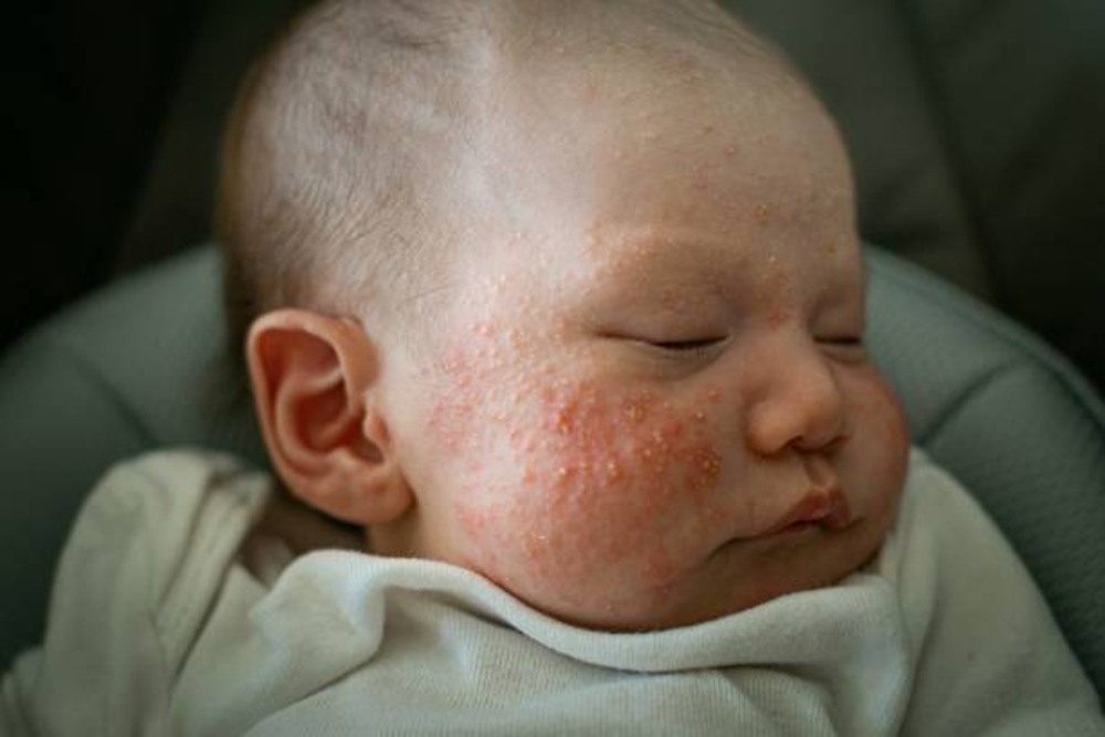 How to Get Rid of Baby Acne: Causes, Prevention, & Treatment
