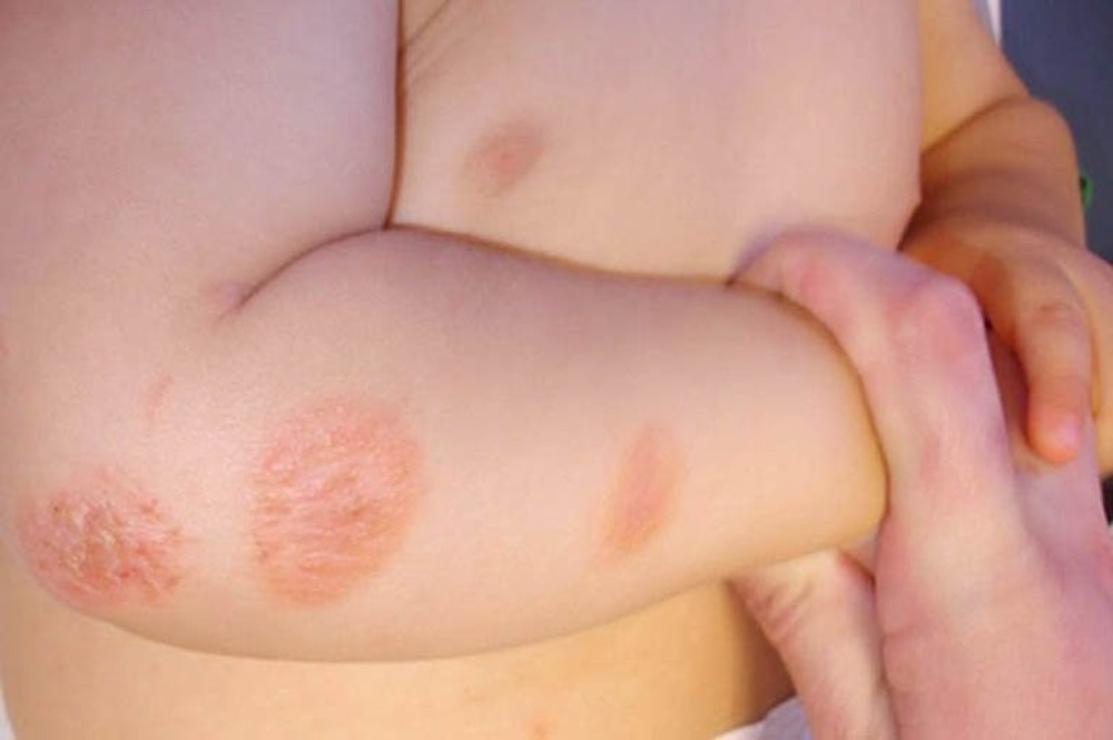 How To Treat Ringworm In Babies Naturally? 10 Effective Ways
