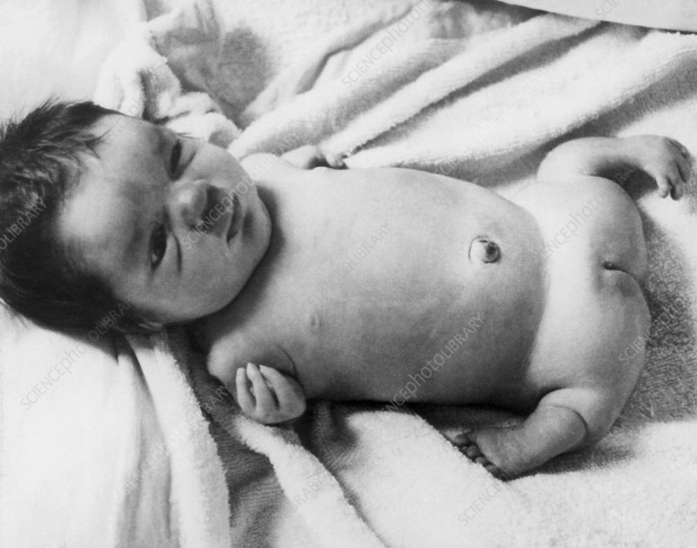 Thalidomide Babies: The Consequences of a Controversial Drug